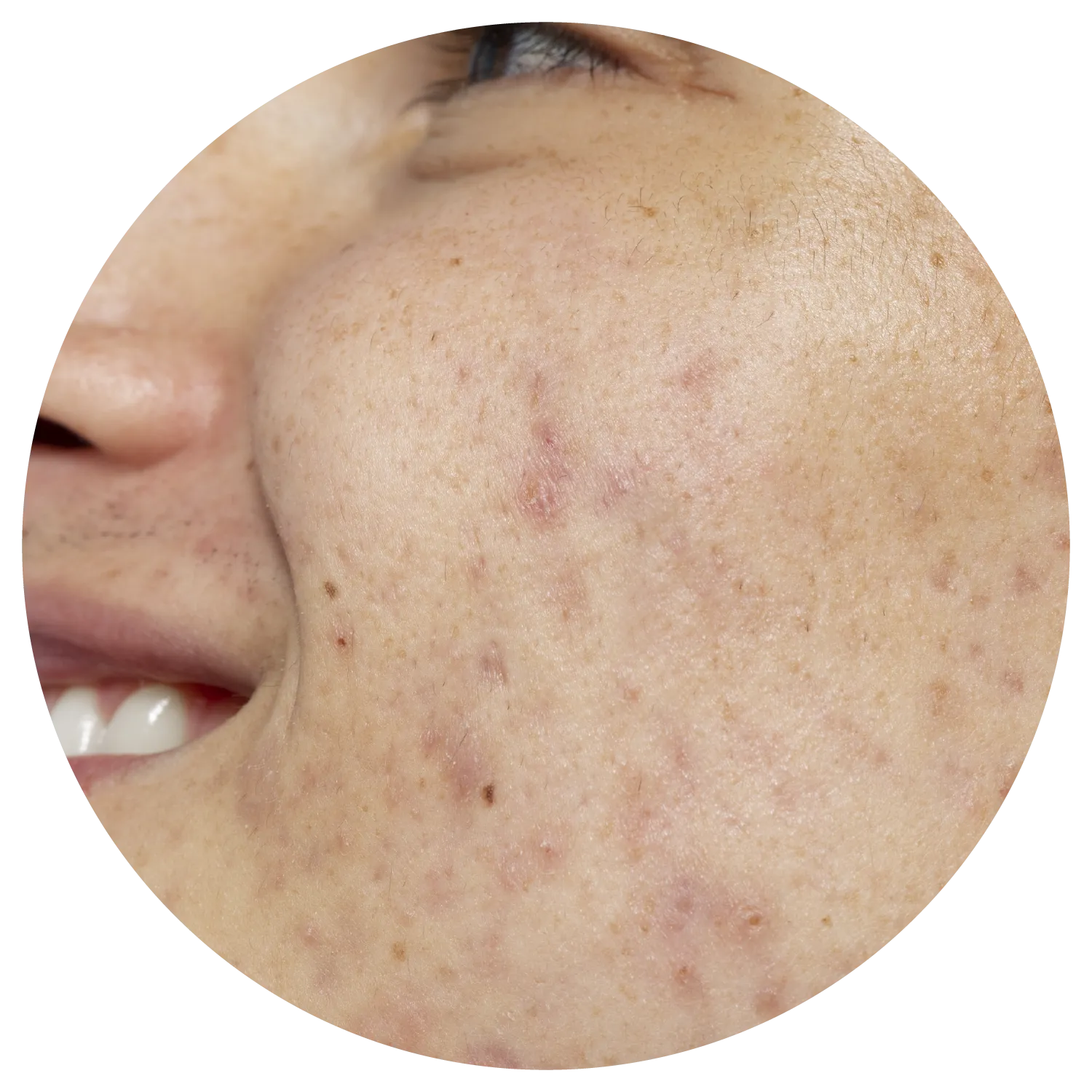 Acne Scarring treatment process at Toronto medical spa - Not all scars are the same—neither are our strategies.